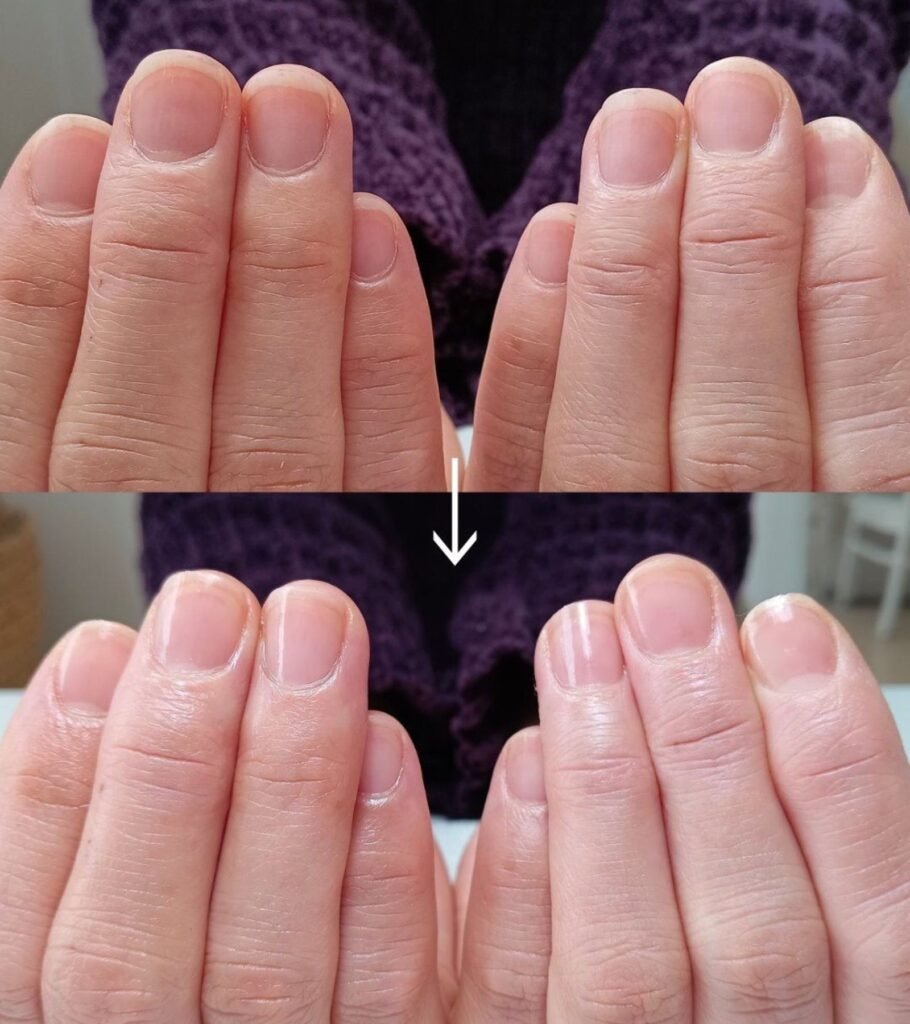 why do acrylic nails hurt and how to keep natural nails healthy after removal