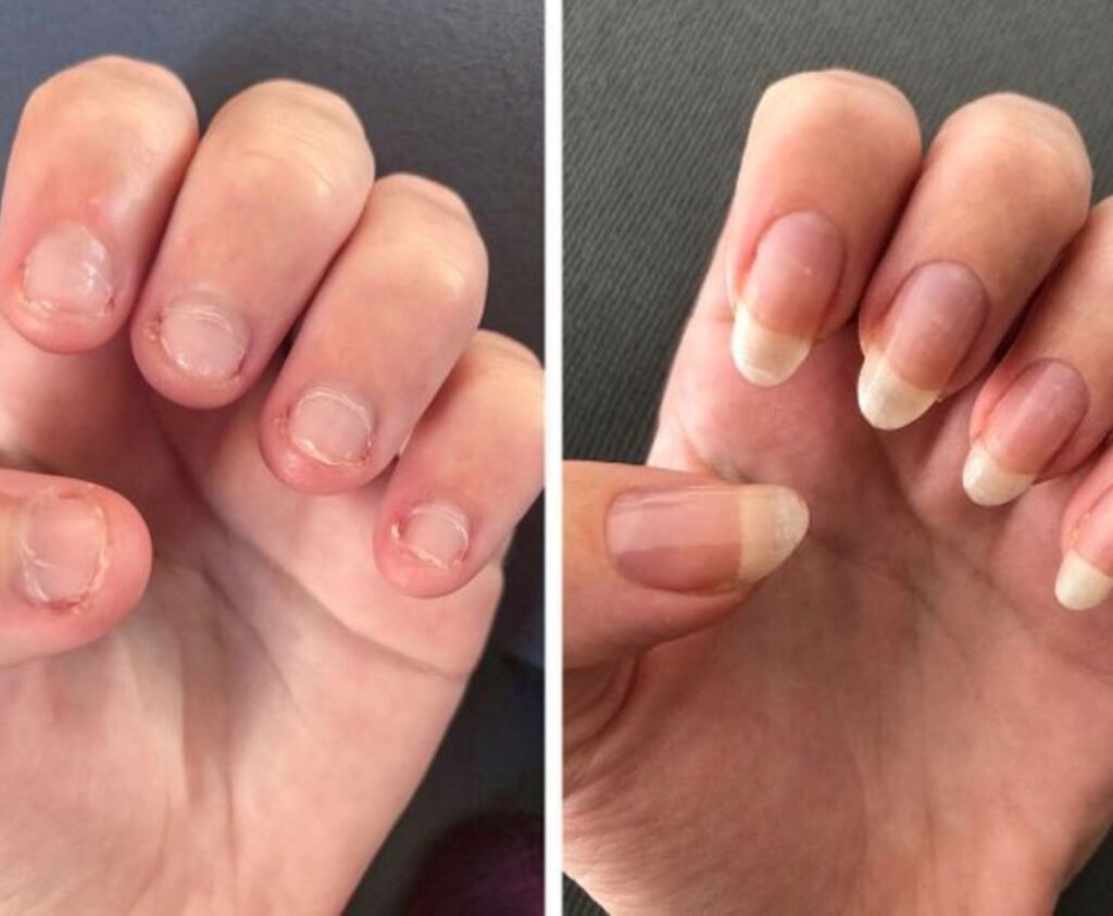 why do acrylic nails hurt because of over filing natural nail damage