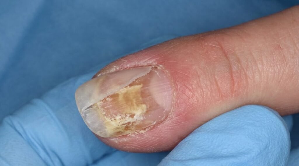 nail fungal infection caused by acrylic nail moisture trapping